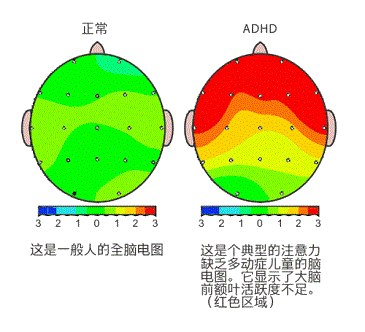 儿童多动症的诱因都有哪些呢?