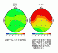 经颅磁治疗仪|如何开发多动症儿童的智力